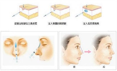 玻尿酸填充苹果肌术后