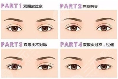 上海九院双眼皮修复案例