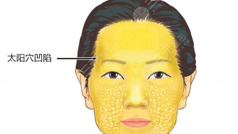 自体脂肪填充太阳穴