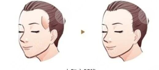 自体脂肪填充太阳穴