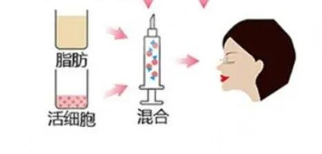 自体脂肪填充太阳穴