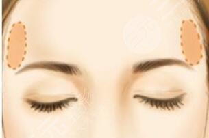 自体脂肪填充太阳穴