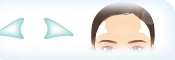 自体脂肪填充太阳穴