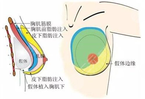 隆胸案例