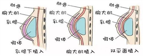 隆胸案例
