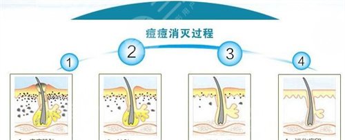 北京摩尔医疗美容激光祛痘案例