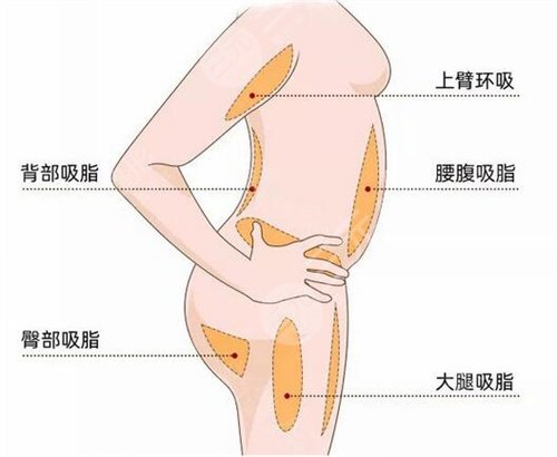 威塑大腿吸脂案例
