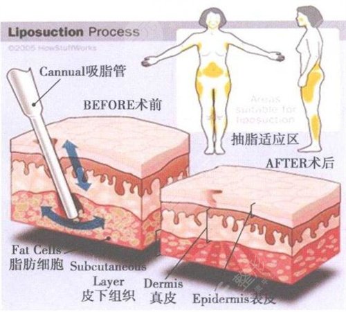 威塑大腿吸脂案例