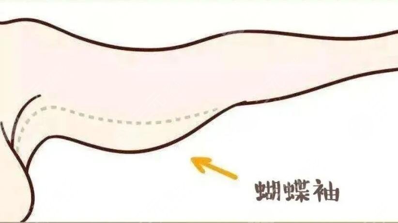 蝴蝶袖吸脂
