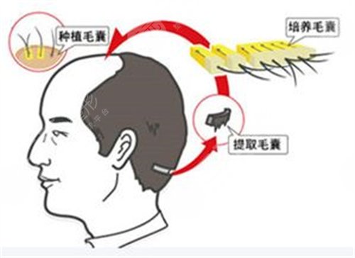 上海剑桥医院植发怎么样？植发医生名单&植发案例果对比图~