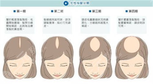 上海剑桥医院植发怎么样？植发医生名单&植发案例果对比图~