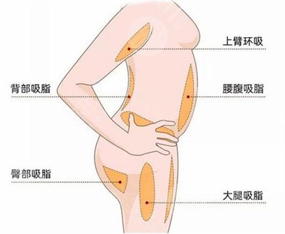合肥赵宇医生吸脂案例分享，术后3个月大象腿变大长腿~