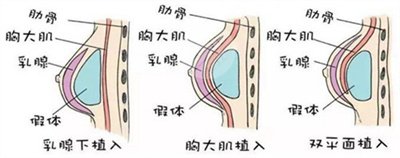 假体隆胸恢复果图片分享，记录术后每一天的变化~