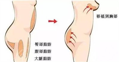 假体隆胸恢复果图片分享，记录术后每一天的变化~