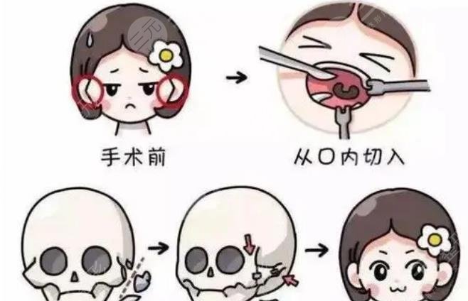 改脸型手术都分哪些?