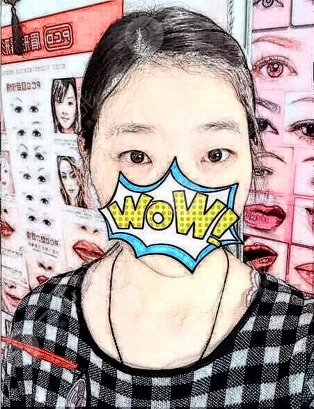 新乡地区割双眼皮手术体验反馈