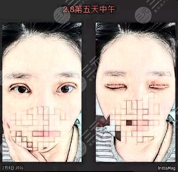 新乡地区割双眼皮手术体验反馈