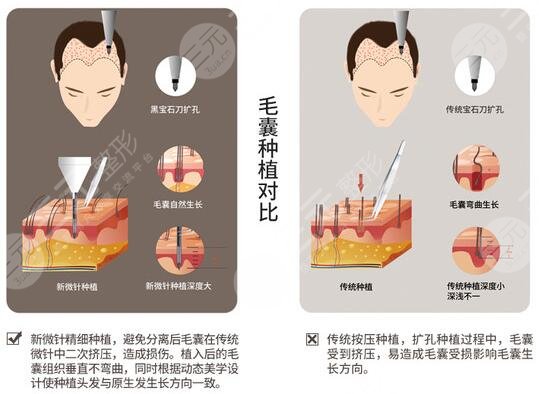 发际线种植