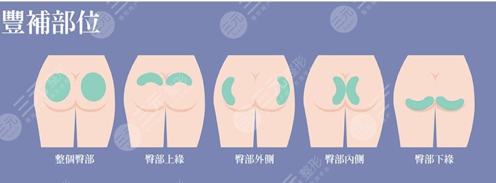 脂肪胶填充臀部