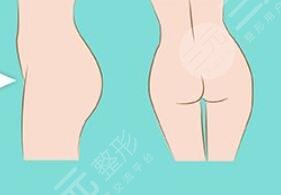 脂肪胶填充臀部