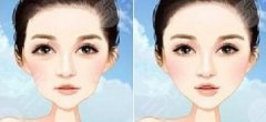 面部自体脂肪填充后下垂怎么办?一起来分析下哇~ 面部自体脂肪填充后下垂怎么办?一起来分析下哇~