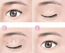 割双眼皮的注意事项有哪些? 割双眼皮的注意事项有哪些?