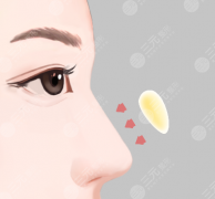 膨体隆鼻果怎么样 看着会假吗? 膨体隆鼻果怎么样 看着会假吗?