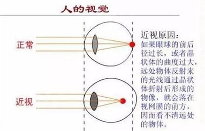 郑州近视激光手术价格