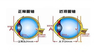 上海近视手术大概多少费用