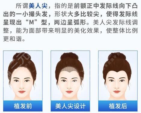 美人尖植发价格是如何算的，多少钱？2022参考价为你分享！