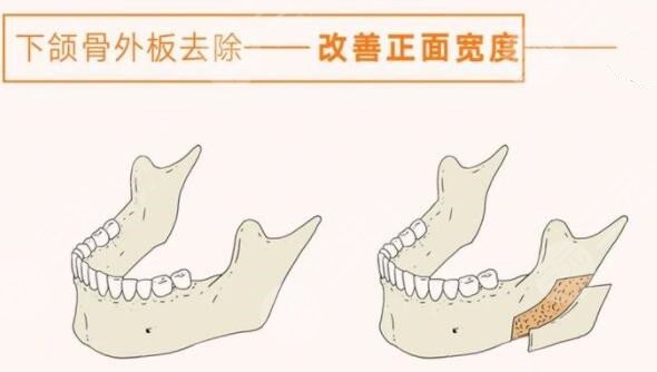 下颌角截骨手术项目案例体验反馈：