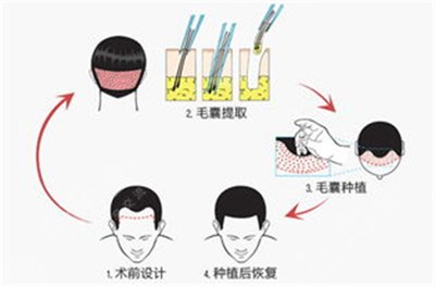 石家庄碧莲盛植发医院发际线种植案例分享