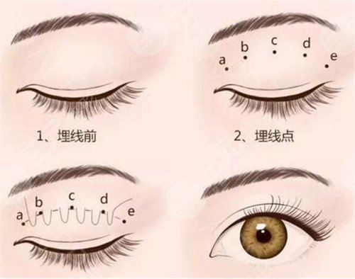 深圳南雅整形美容医院双眼皮手术案例：
