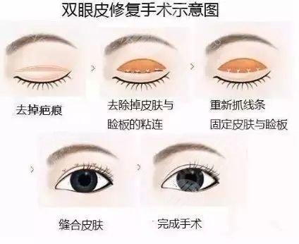临沂人民医院整形科是怎么收费的？价格表+专家名单+修复双眼皮案例~