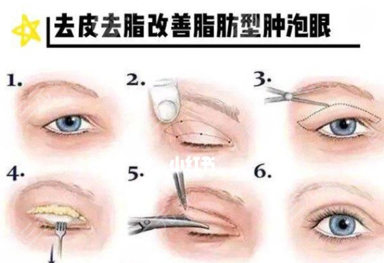 眼部吸脂手术费用盘点，手术有什么危害？