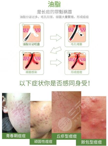 激光去青春痘多少钱？对身体有影响吗？