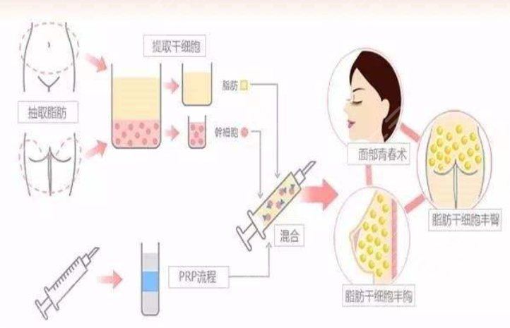 自体脂肪活细胞除皱多少钱？康康小姐姐的案例吧~