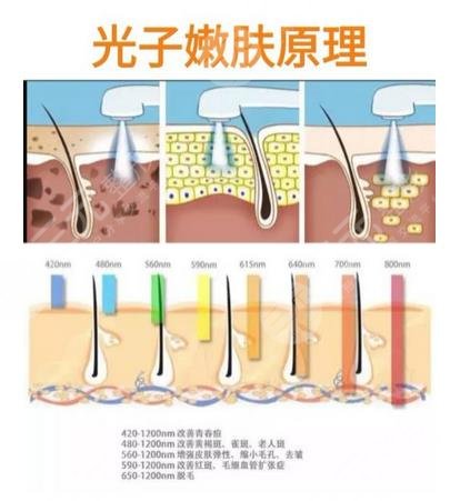 面部射频溶脂的原理是什么?
