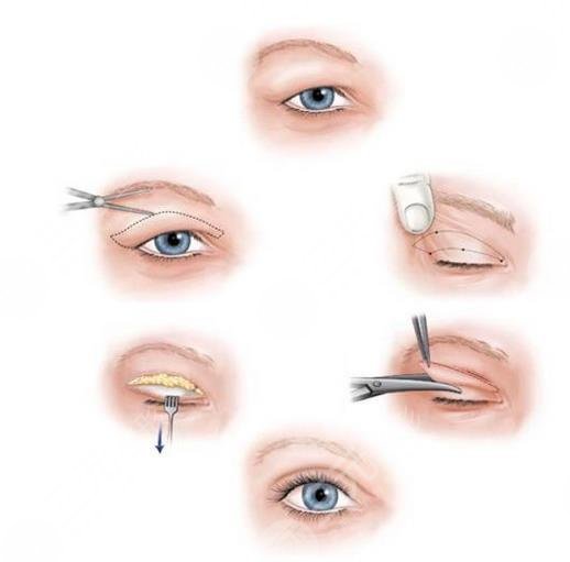 全切双眼皮加开眼角整形同时进行，比单纯的进行切开双眼皮手术好吗?