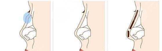 上海九院鼻部手术整形科普