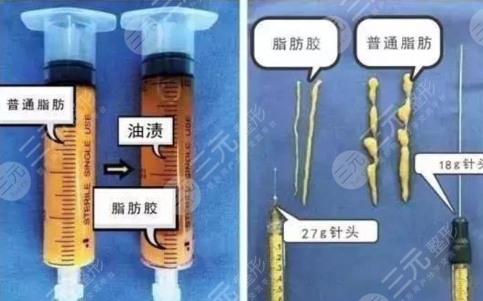 隆胸