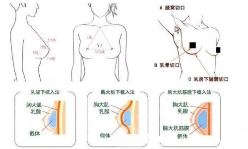 棉花糖隆胸后的注意事项是什么?