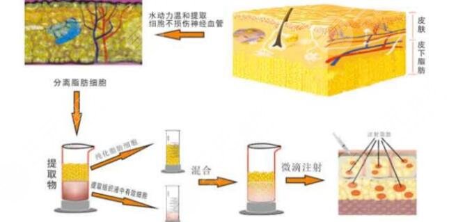 北京润美玉之光做脂肪填充科普