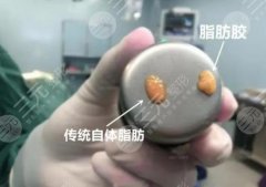 脂肪胶是什么材料，和普通脂肪有什么区别？科普介绍填充“黑科技”！