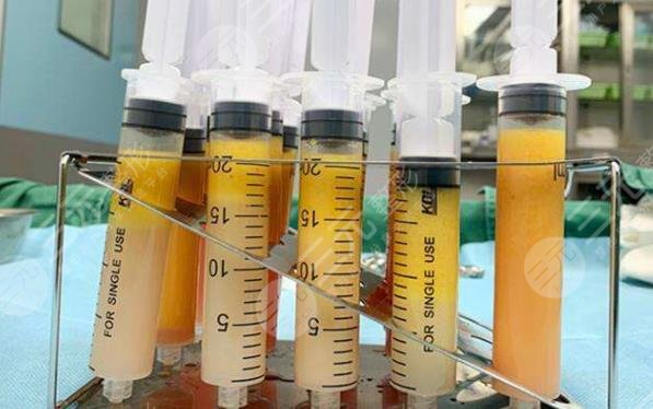 脂肪胶和自体脂肪区