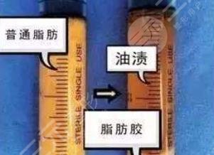 脂肪胶和自体脂肪区