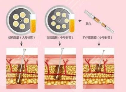 脂肪胶和自体脂肪区