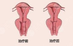 做缩阴手术多久能过性生活？恢复期注意事项贴心分享！
