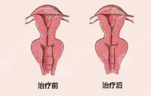 缩阴手术