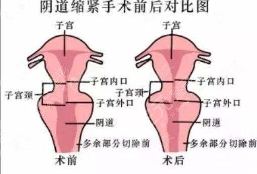 缩阴手术
